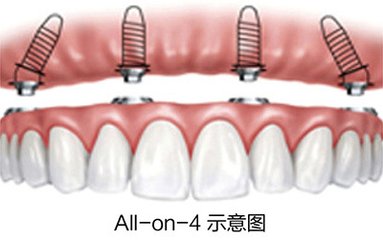 全口种植牙技术