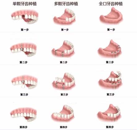 单颗、多颗以及全口种植牙操作演示图