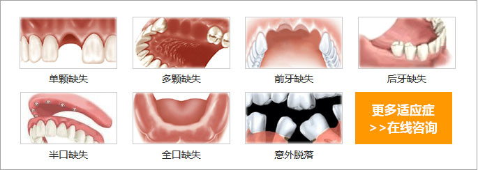 全口牙缺失种植牙方法