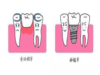 全口活动假牙和全口种植牙哪个好