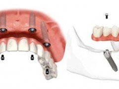 牙齿全部缺失要做多少颗种植牙