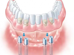 全部牙齿缺失后种植多少钱
