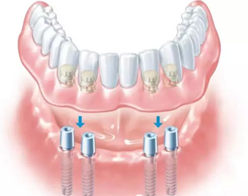 全部牙齿种植多少钱