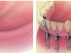 种植牙修复全口牙缺失结果好吗