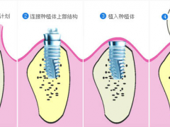 全口种植牙适合老年人吗