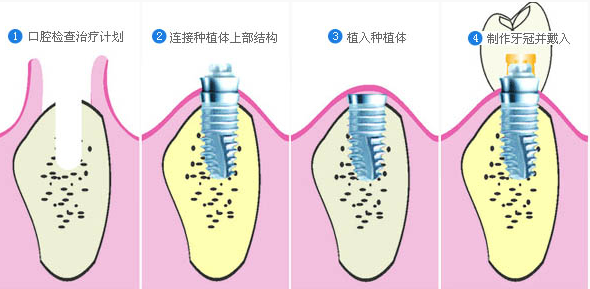 全口种植牙适合老年人吗？