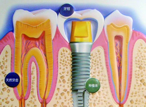 种植牙重新塑造无缺陷牙