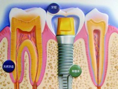 种植牙重新塑造无缺陷牙