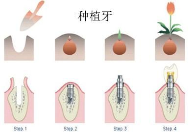 全口牙齿缺失种植牙