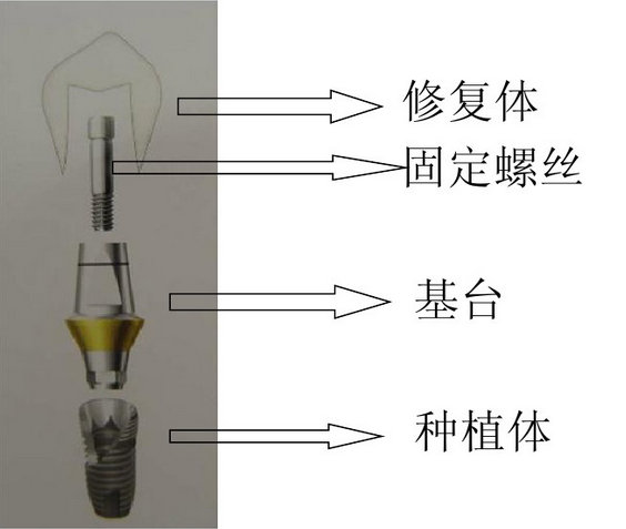 全口种植牙手术全过程及所需时间