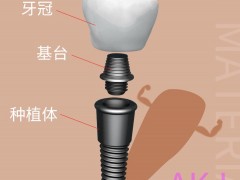 后牙缺失是否可以做种植牙呢