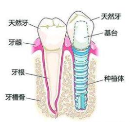 种植牙和真牙