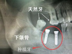 烤瓷牙坏了，能种植牙吗