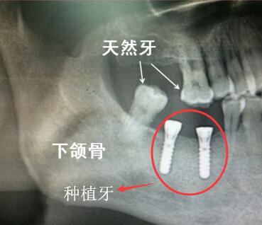 真牙与种植牙