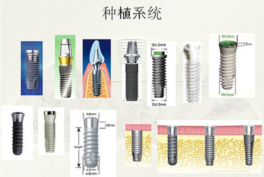 德国种植牙价格