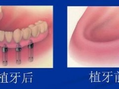 口腔种植牙价格