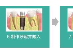 做种植牙手术过程详解