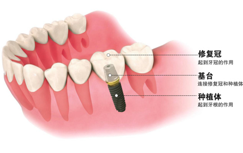 深圳福田种植牙的价格