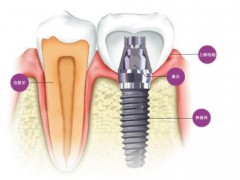 后牙种植用什么材料好