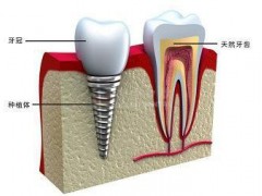 后牙种植牙的注意事项