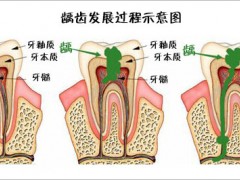 深圳儿童补牙洞哪个医院好