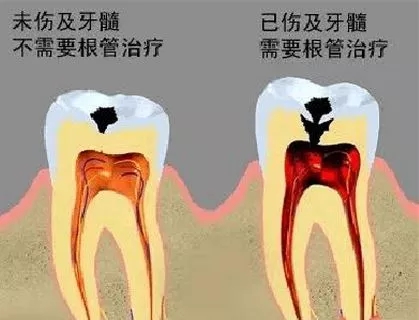 有牙洞要不要做根管治疗