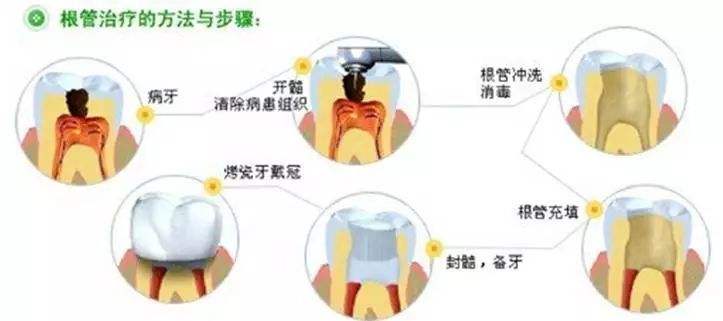 根管治疗补牙