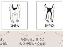 乳牙不及时治疗会有什么影响