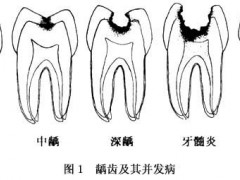 1岁宝宝奶瓶龋怎么治疗