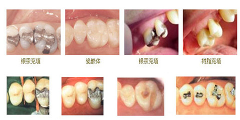 儿童龋齿检查