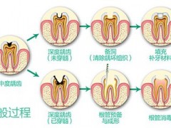 家长怎么检查孩子是否蛀牙了？