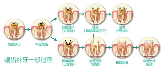 怎么检查是否蛀牙