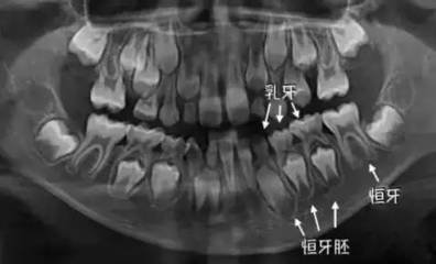 乳牙不是要换的吗，怎么要补牙