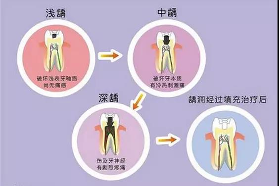 儿童乳牙龋齿要不要治疗