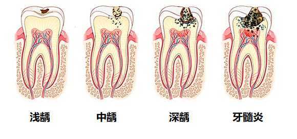 孩子蛀牙怎么办