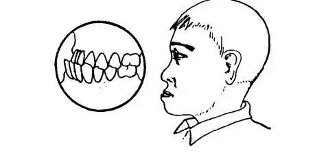 儿童牙齿反颌矫正什么时候好