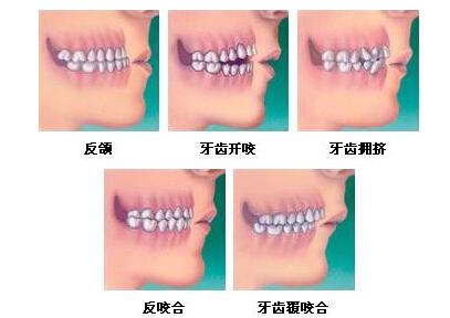 小孩整牙多少钱