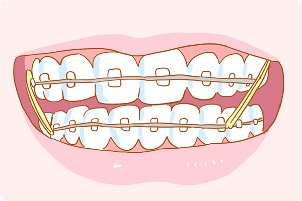 儿童矫正门牙牙齿方式