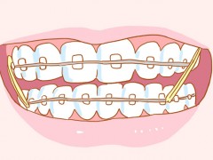 儿童矫正门牙牙齿