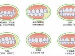 儿童错颌畸形矫正多少钱