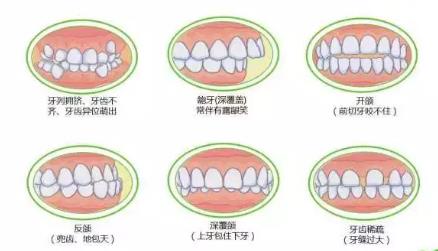 儿童错颌畸形矫正