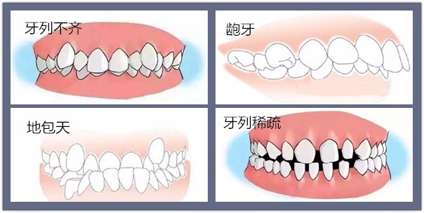 儿童龅牙什么时候矫正