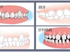 儿童龅牙什么时候矫正