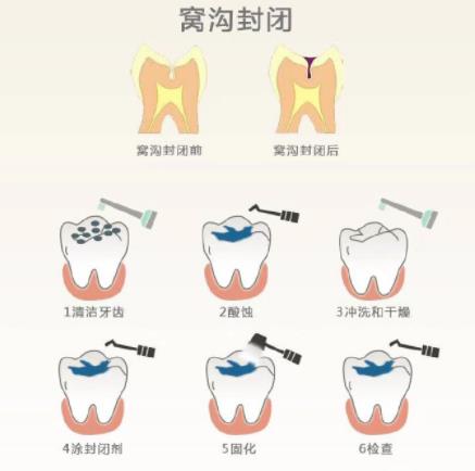 窝沟封闭剂操作过程