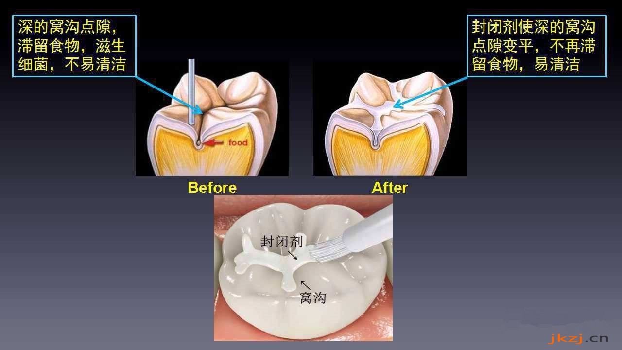 窝沟封闭做还是不做一看便知