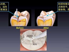 窝沟封闭背不起“做完容易烂牙”的大黑锅