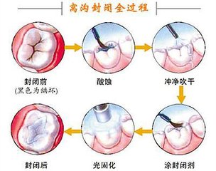 做窝沟封闭疼吗