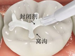 孩子几岁做窝沟封闭好