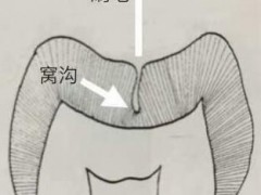 做了窝沟封闭就不会得虫牙了吗