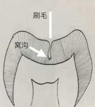 窝沟封闭